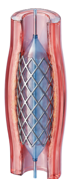 Coronary Angioplasty with Stenting