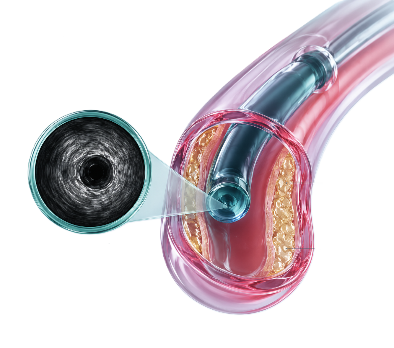 IVUS (Intravascular Ultrasound)